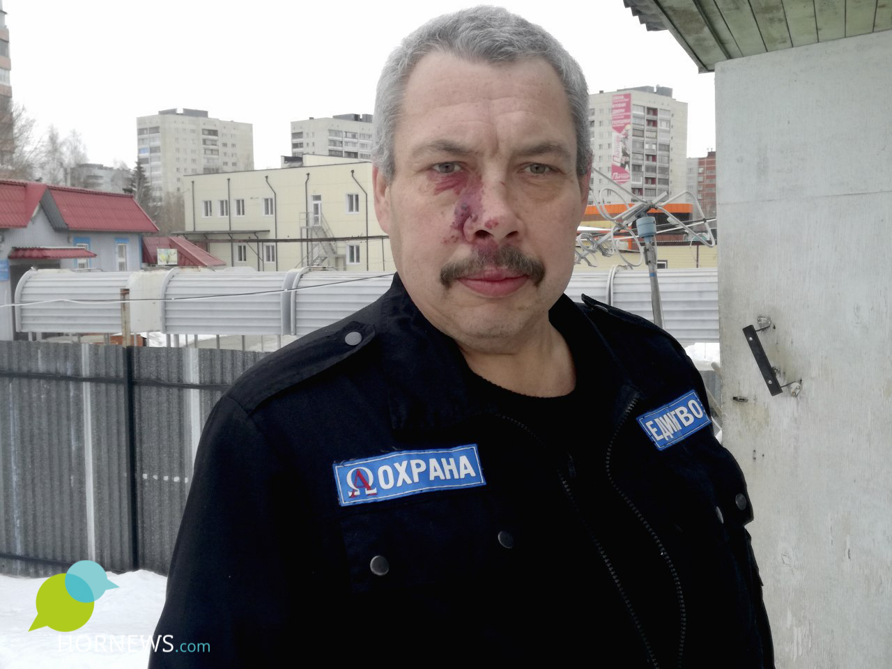 С рождения у Сергея на лице родимое пятно